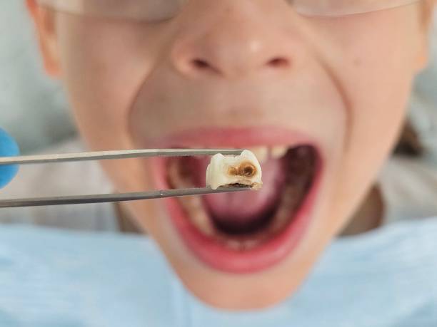 Best Tooth Infection Emergency Dentist  in Hot Springs, SD